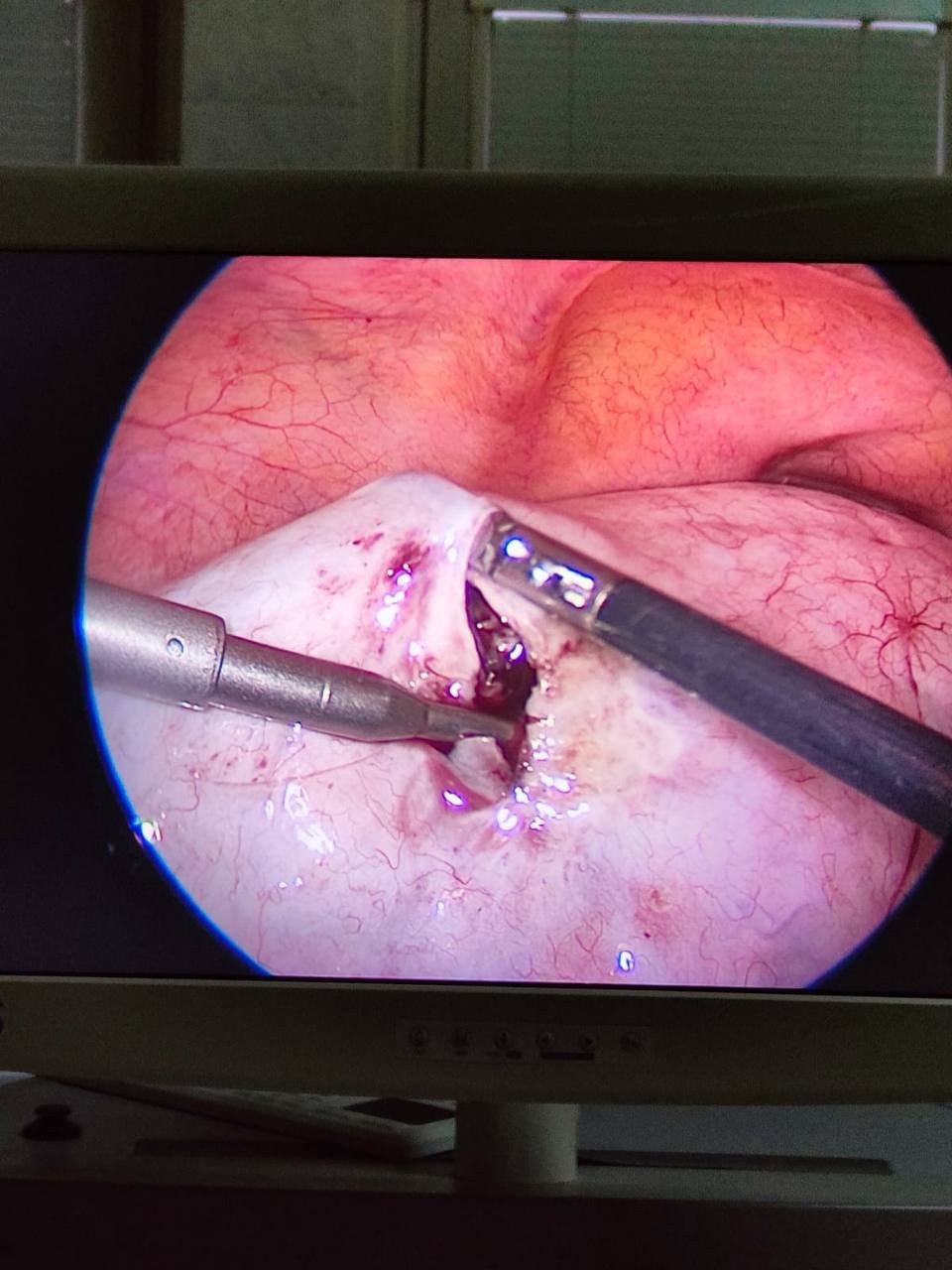 Успешное удаление гигантской кисты яичника в КБ №8