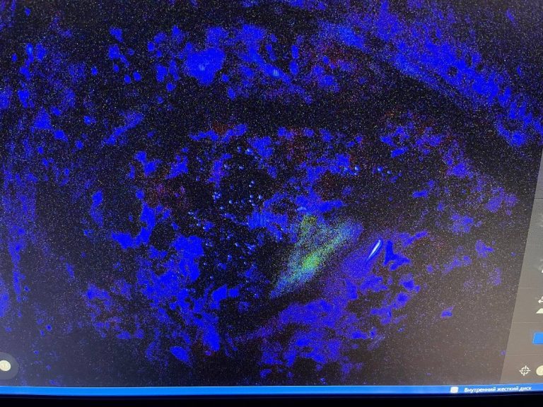 federalnyy tsentr mozga i neyrotekhnologiy fmba rossii vnedryaet novyy podkhod k lecheniyu glioblastomy 3